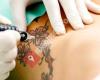 Skinial Schweiz - Tattooentfernung ohne Laser